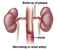 Illustration of Renal Artery