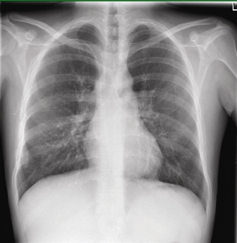 X-ray image os lungs 21 days post-transplant