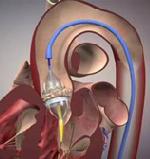 inflated balloon catheter securing a replacement valve in the heart