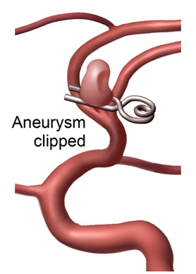 Aneurysm Clipped
