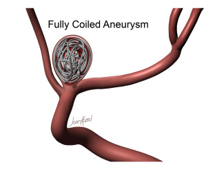 Aneurysm Coil