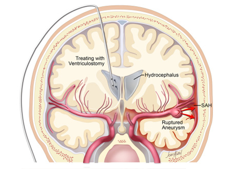 Ventriculostomy