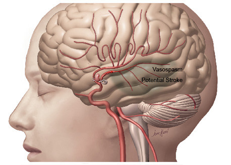 Vasospasm