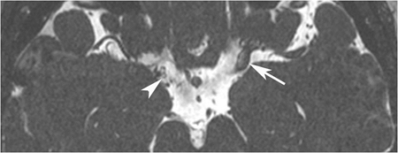 Moyamoya MRI diagnosis