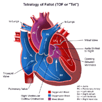 Anatomy of a heart with tetralogy of Fallot