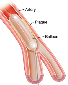 Cross section of artery with plaque showing balloon angioplasty.