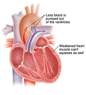 Cross section of dilated heart with systolic heart failure.