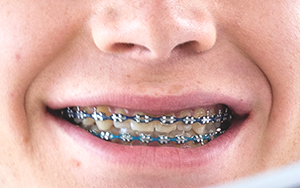 Closeup of teeth with braces.