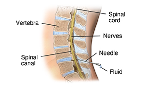 Side view cross section of lower spine showing needle inserted for lumbar puncture.