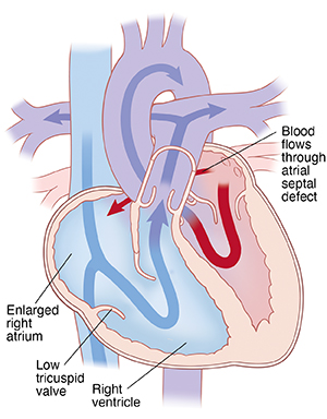 Four-chamber view of heart showing Ebstein anomaly, incluing enlarged right atrium, low tricuspid valve, and atrial septal defect. Arrows indicate blood flow through heart.
