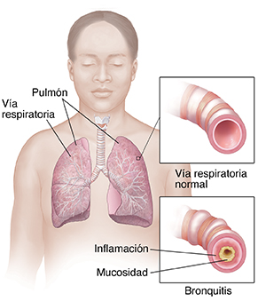 Vista frontal del cuerpo de una mujer en donde se observa el sistema respiratorio. Recuadros en los que se observan una vía respiratoria normal y una vía respiratoria con bronquitis.