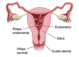 Corte transversal del útero donde se observan pólipos dentro del cuello uterino y sobre este.