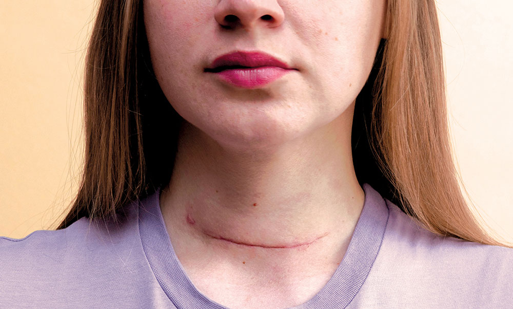 Traditional thyroid surgery can result in a two-inch scar.