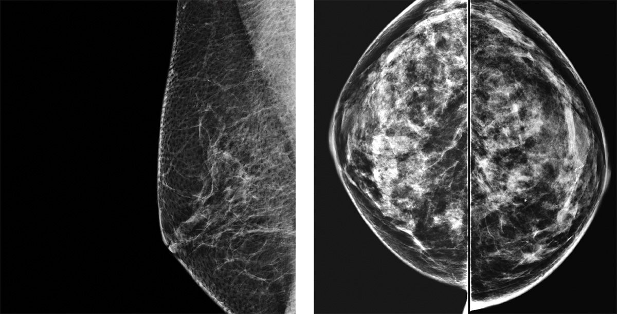 BREAST-DENSITY CHANGES LINKED TO CANCER RISK - Illustration