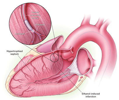 Illustration of Alcohol Septal Ablation Procedure