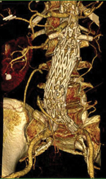 Digital image of a fenestrated stent repairing an abdominal aortic aneurysm
