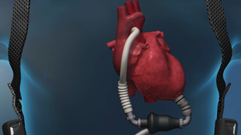Heart Transplant | Transplant | Barnes-Jewish Hospital