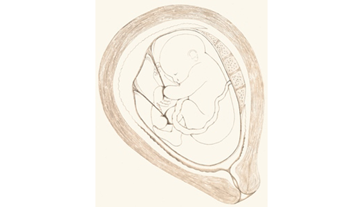 Amniotic Band Syndrome diagram