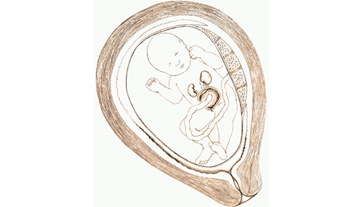 Bladder Outlet Obstruction diagram