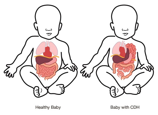 Diagram comparing a healthy baby's anatomy to one with CDH