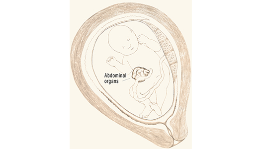 Fetal Gastroschisis diagram