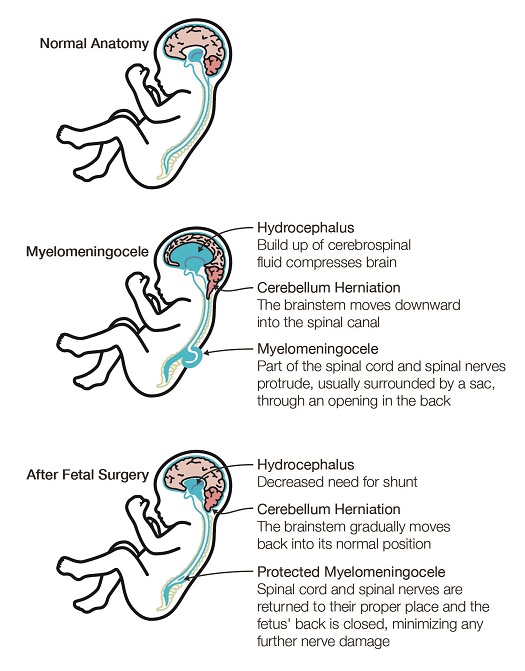 Diagram of the anatomy of Myelomeningocele (Spine Bifida)