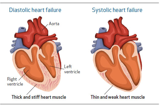 treatment for cardiac dyspnea