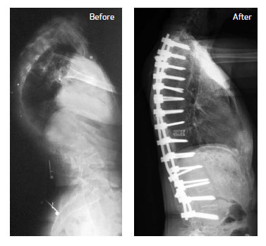 effective treatment for severe spinal curvature