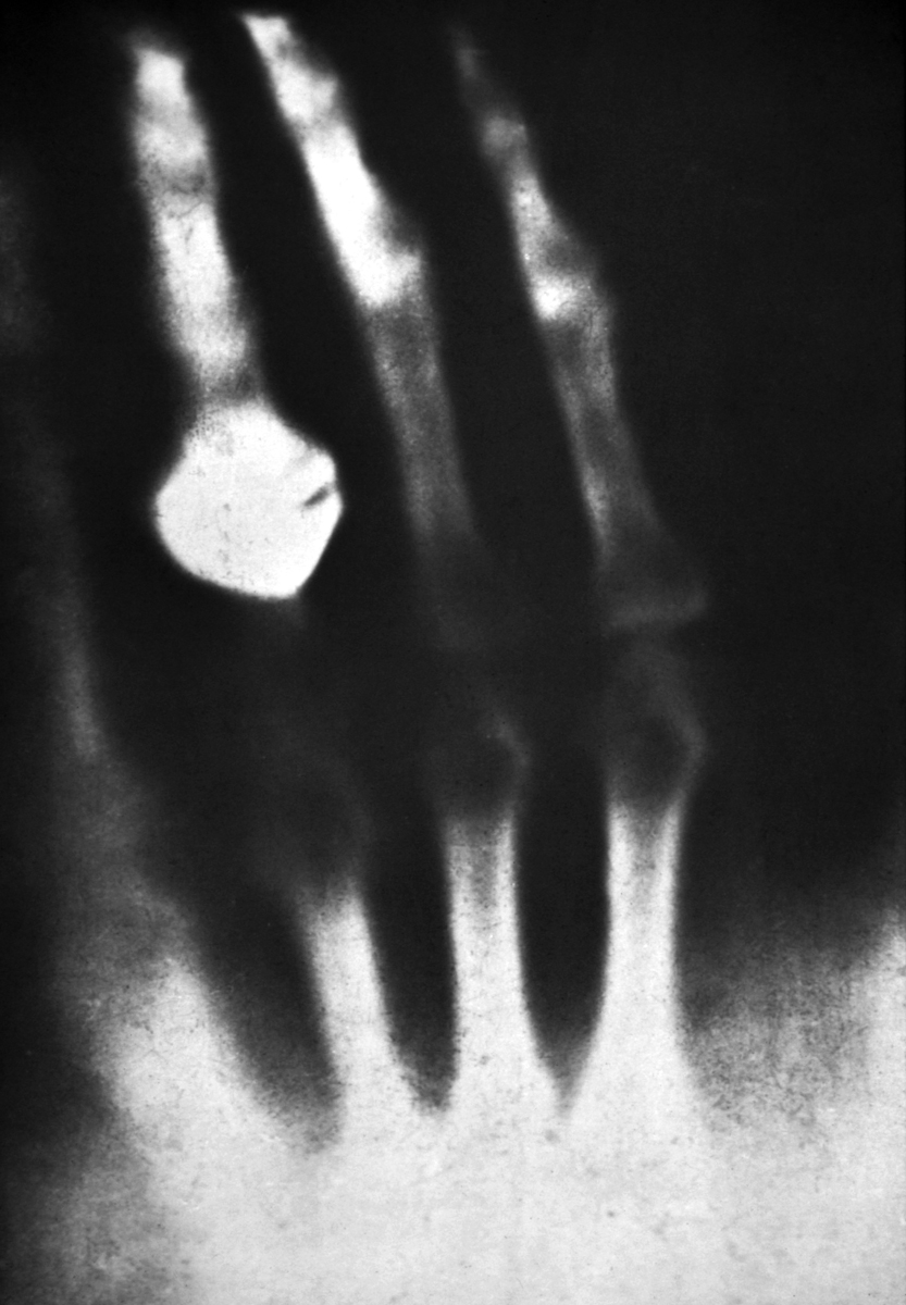 William Röntgen produced the first X-ray of a human body in 1895. Photo courtesy of Science Photo Library