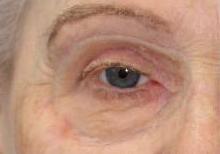Patient with orbital prosthesis