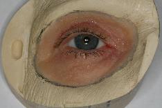 Orbital Prosthesis