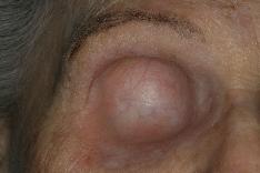 Patient without orbital prosthesis