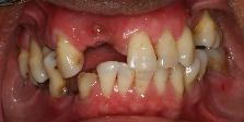 Before full mouth reconstruction using dental implants