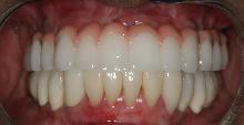 After full mouth reconstruction using dental implants